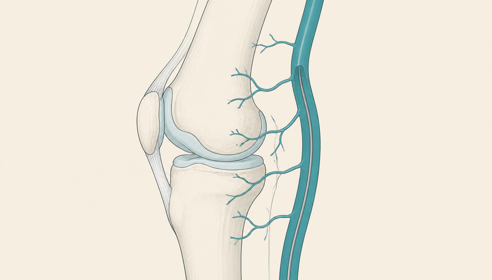 Illustration of the knee with the popliteal artery, genicular arteries and microcatheter for embolization