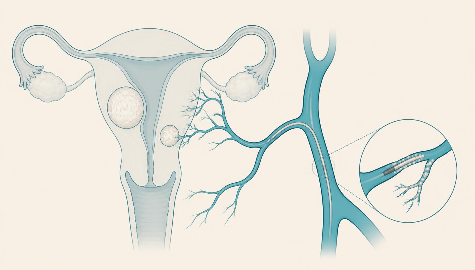 Illustration of the uterus with fibroids and catheter in the uterine artery for embolization