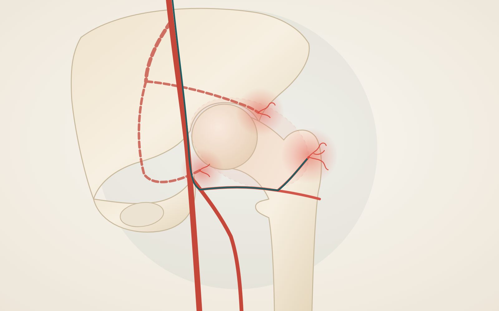 Illustration of the hip with three areas of inflammation, on the outer side, behind the joint and towards the groin, and the arterial branches that reach them