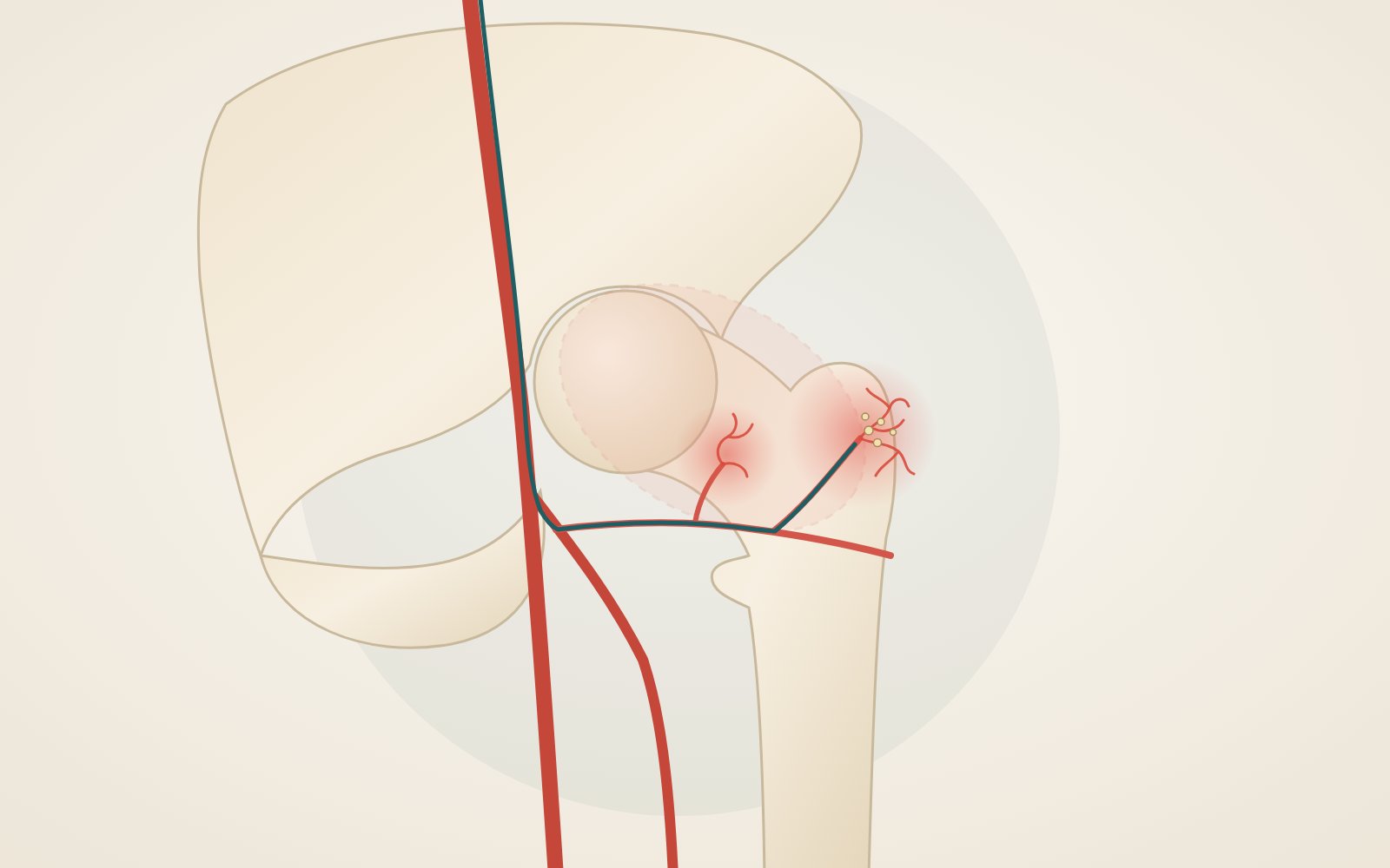 Illustrazione dell'anca con piccoli vasi infiammati intorno all'articolazione e al gran trocantere e microcatetere in un ramo dell'arteria circonflessa femorale
