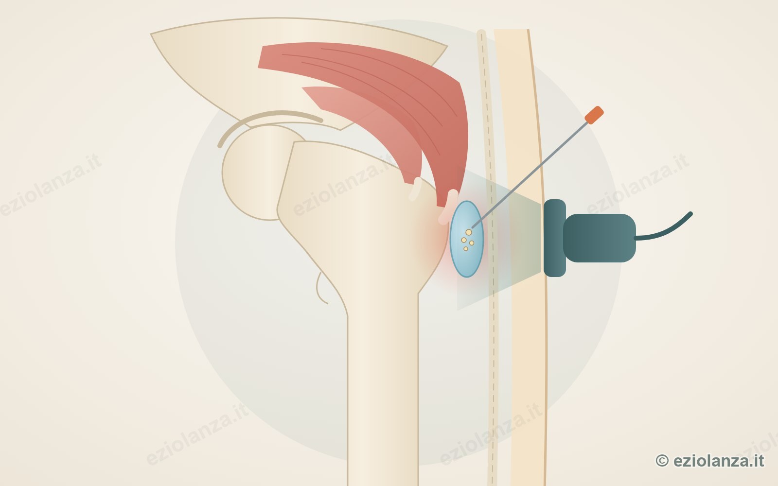 Illustration of the side of the hip with the greater trochanter, the gluteal tendons and the inflamed bursa, reached by a thin needle guided by the ultrasound probe