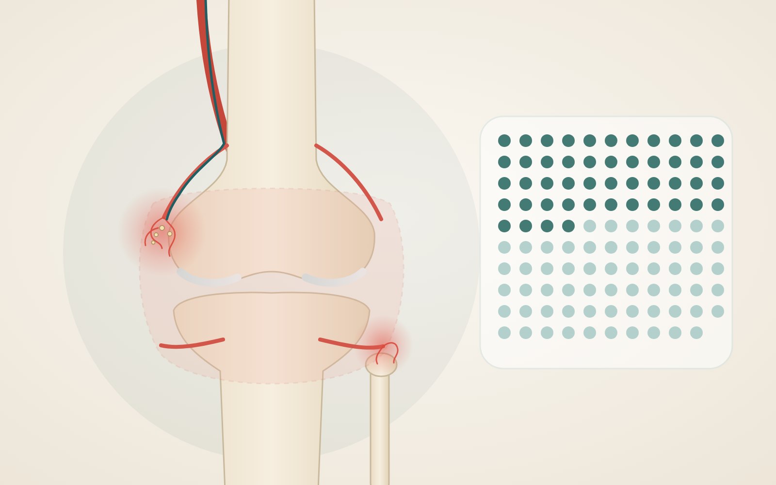 Illustration of the knee with the genicular arteries, the inflamed synovium and the microcatheter, next to a grid of 109 dots representing the registry's centres