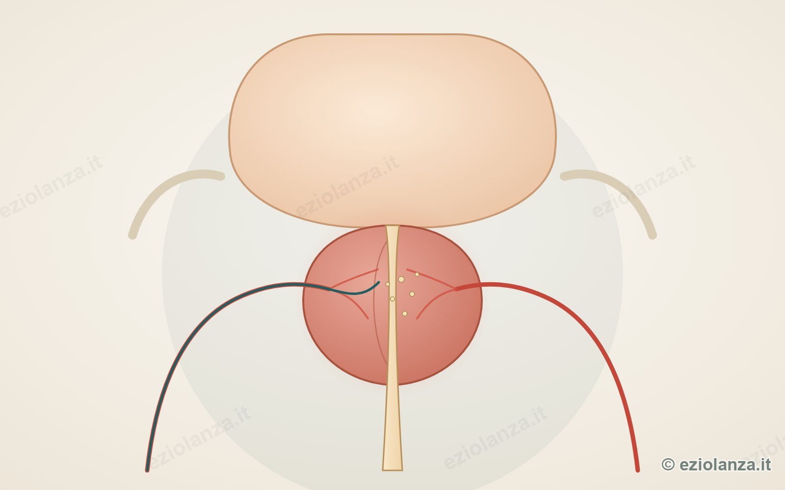 Illustrazione della vescica e della prostata, ingrossata per ipertrofia benigna, che stringe l'uretra, con le arterie prostatiche e il microcatetere che rilascia le microparticelle