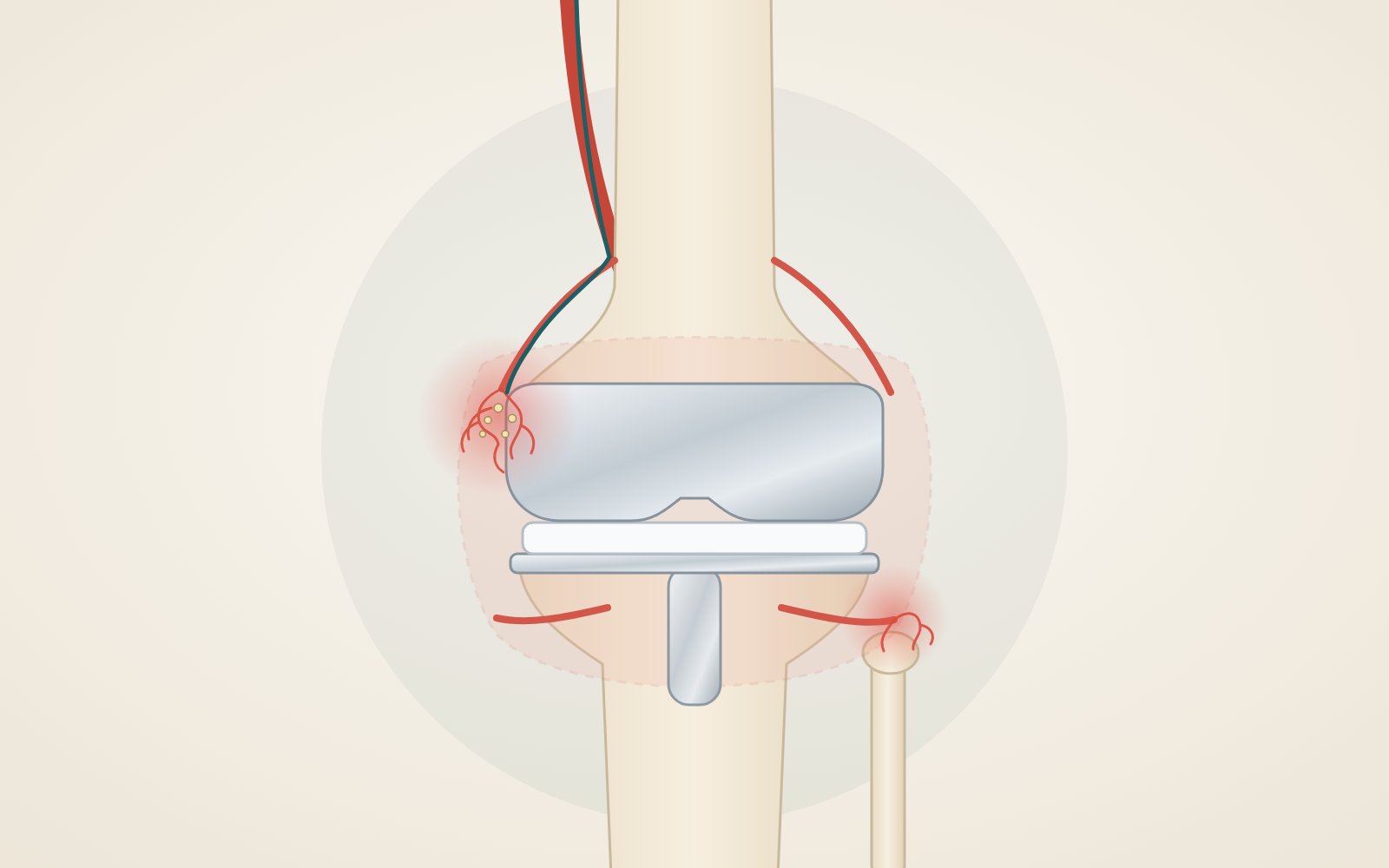 Illustrazione di una protesi di ginocchio con piccoli vasi infiammati intorno all'articolazione e microcatetere in un'arteria genicolata