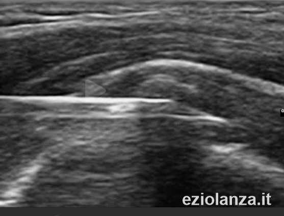 Real ultrasound image of the needle during ultrasound-guided lavage of a rotator cuff tendon calcification