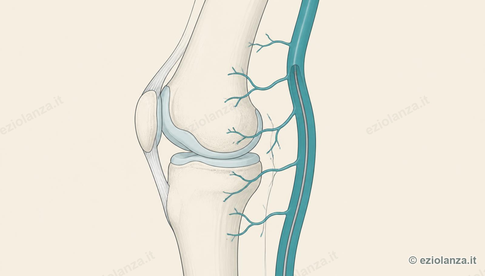 Illustration of the knee with the genicular arteries and the microcatheter reaching the small inflamed vessels
